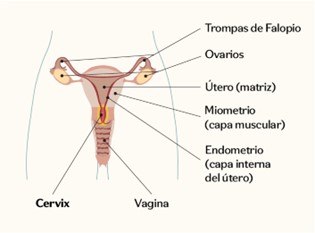 Ilustración del cáncer de cérvix