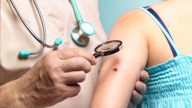Melanoma: causas, síntomas, diagnóstico y tratamiento.