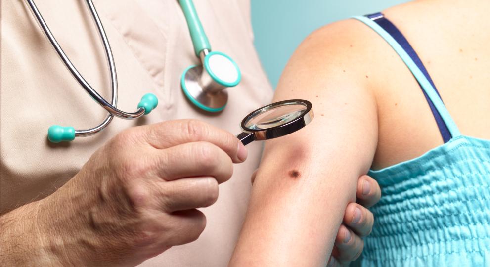 Melanoma: causas, síntomas, diagnóstico y tratamiento.